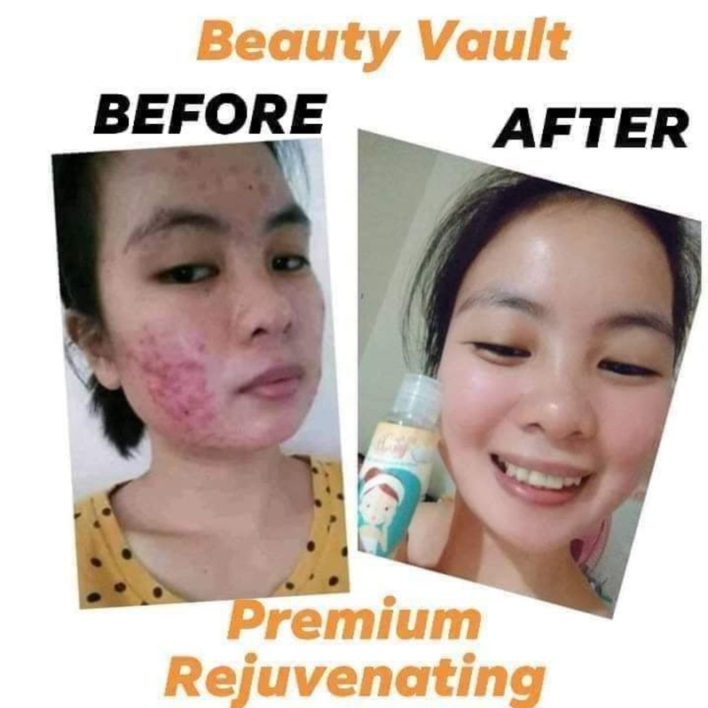 Beauty Vault Anti-Acne Pimples  100% Effective